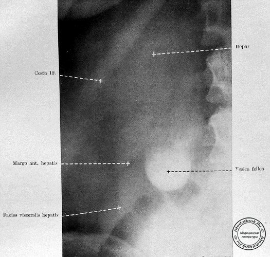 Рентгеновский снимок печени и желчного пузыря: контрастное вещество находится на дне желчного пузыря (холецистограмма)
