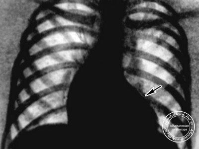 Рентген сердца