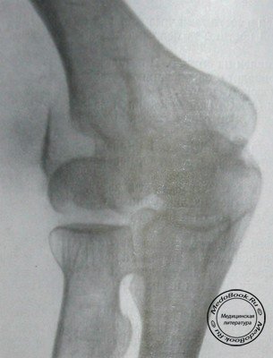 Рентгеновский снимок перелома мыщелков плечевой кости в прямой проекции