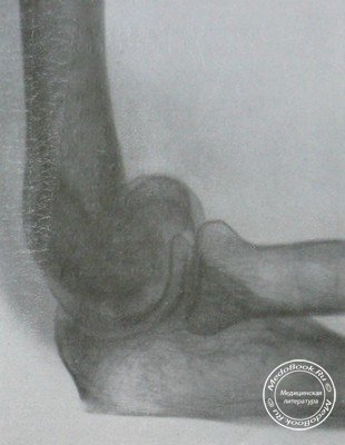Рентгеновский снимок перелома мыщелков плечевой кости в боковой проекции №1