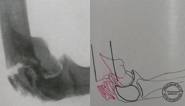 Рентгеновский снимок перелома мыщелков плечевой кости в боковой проекции №2