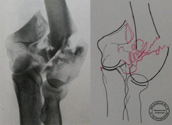 Рентгеновский снимок перелома мыщелков плечевой кости в задней проекции