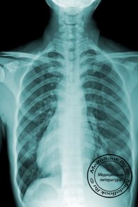 Рентгенодиагностика повреждений сердца и других органов средостения
