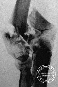 Перелом мыщелков плечевой кости и их рентгенологическая диагностика