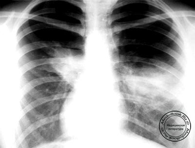 Рентген больного с аллергическим бронхолегочным аспергиллезом
