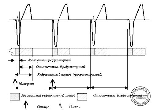 Рефрактерный период электрокардиостимулятора после стимулирующего импульса
