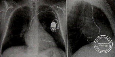 Рентген имплантированного электрокардиостимулятора