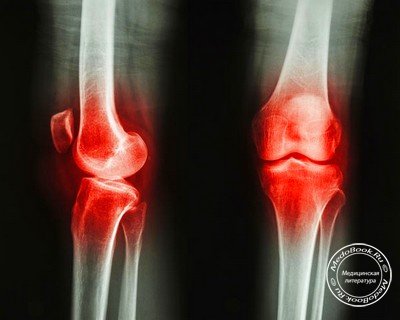 Закрытое повреждение колена