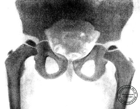 Рентгенограмма тазобедренных суставов ребенка 6 лет, страдающего болезнью Фейрбанка