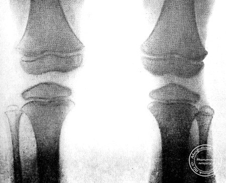 Рентгенограмма коленных суставов ребенка 7 лет, страдающего болезнью Фейрбанка