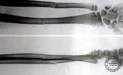 Перелом предплечья и отслоение эпифиза на рентгеновском снимке