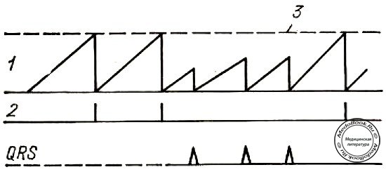 Иллюстрация принципа работы цепи запирания кардиостимулятора (ЭКС)