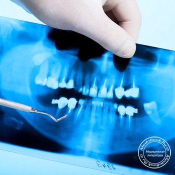 Особенности рентгенографии зубов верхней челюсти