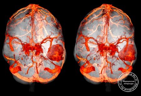 Компьютерная томография головного мозга с болюсным контрастным усилением