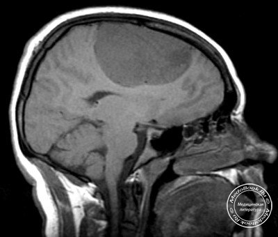 МРТ снимок менингиомы у ребенка 16 лет