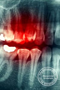 Рентгенография передних зубов нижней челюсти