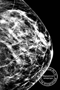 Дуктография - контрастная маммография