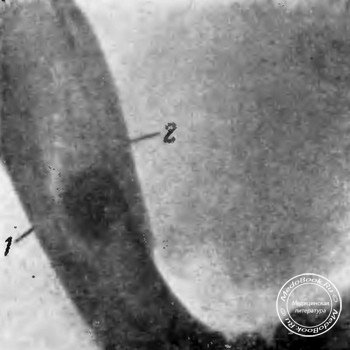 Рентгеновский снимок задних зубов нижней челюсти (осевой)