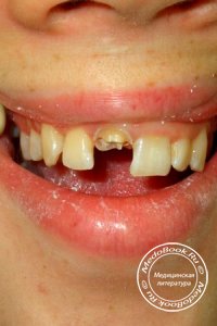 Способы восстановления зубов
