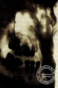 Рентгенография зубов нижней челюсти внутриротовым способом вприкус
