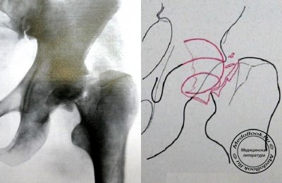 Рентгеновский снимок вывиха в тазобедренном суставе с переломом шейки бедренной кости