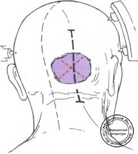 Схема парамедиального доступа к менингиомам намета мозжечка
