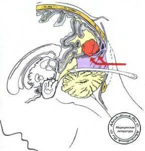 Этап операции удаления супратенториально расположенной менингиомы мозжечка из супрацебеллярного субтенториального доступа