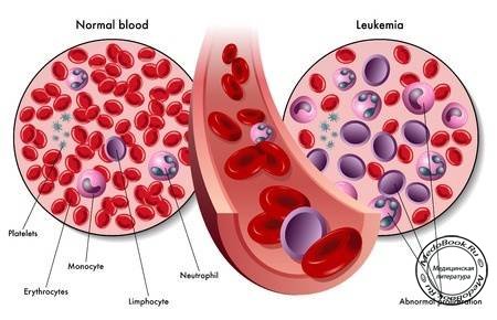Нормальная кровь и лейкоз