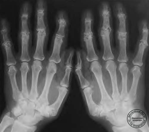 Эрозивный остеоартроз кистей рук (фото)
