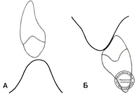Форма апикальной части зуба протеза