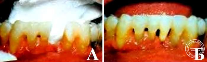 Адгезивный шинирующим протез с естественным зубом на нижнюю челюсть