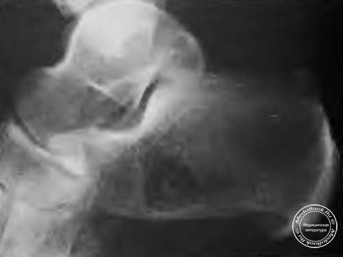 Липома пяточной кости (рентген)