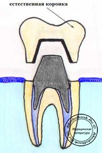 Зубной протез с естественным зубом