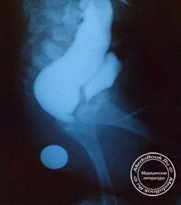Атрезия ануса на рентгене