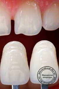 Адгезивные керамические реставрации - новое решение в стоматологии