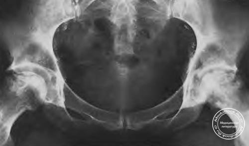 Двусторонний аваскулярный некроз головок бедренных костей