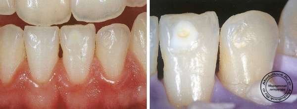 Вид зубов до процедуры макроабразии