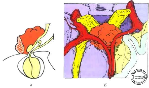 Схема топографоанатомических отношений менингиомы бугорка турецкого седла (супрахиазмальный вариант)