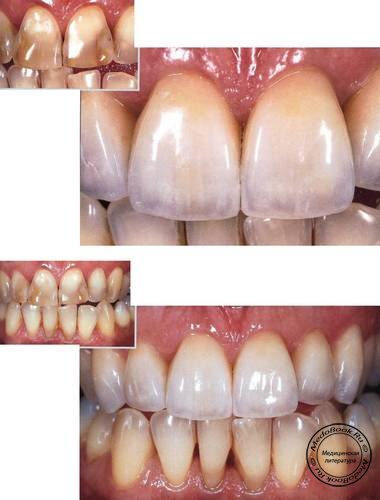 Лечение эрозий эмали передних зубов верхней челюсти
