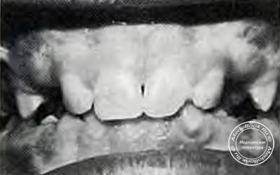 Поверхностные пятна на вестибулярной поверхности зубов ребенка