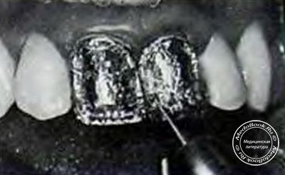 Бором №33½ в металле создают механические ретенционные пункты