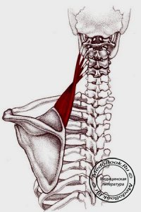 Боль в мышце, поднимающей лопатку: лечение блокадой