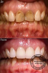 Лечение внутренних дисколоритов зубов