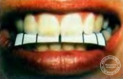 Фронтальные зубы пациента находятся в золотой пропорции