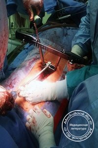 Хирургические вмешательства при остром животе: анестезия