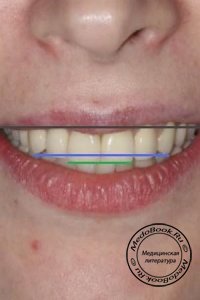Симметрия и пропорциональность зубов в эстетике улыбки