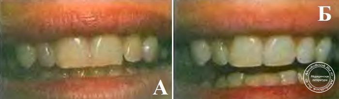 Косметическая коррекция неровных режущих краев зубов