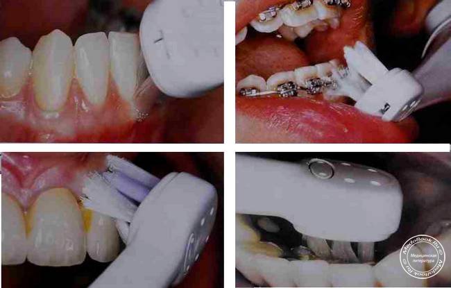 Чистка зубов электрической щеткой Интерплак