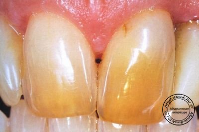 Зубы с оголенным дентином