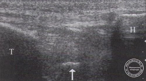 Продольная сонограмма переднего отдела коленного сустава